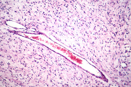 Photomicrograph of a neurofibroma tissue sample in neurofibromatosis disease, revealing...