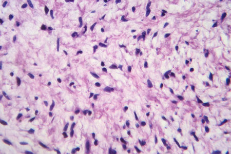 Photomicrograph of a neurofibroma tissue sample in neurofibromatosis genetic disease under a...