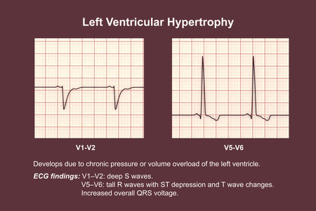 Left ventricular hypertrophy, 3D illustration showing ECG leads V1-V2 with deep S waves and...