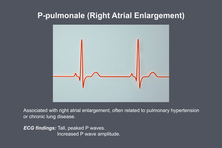P-pulmonale, 3D illustration showing ECG with tall peaked P waves consistent with right atrial activation pattern.の写真素材
