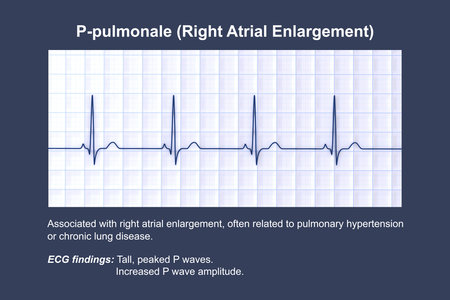 P-pulmonale, 3D illustration showing ECG with tall peaked P waves consistent with right atrial...