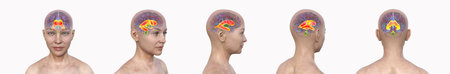 Enlarged lateral ventricles of the human brain (hydrocephalus) in multiple anatomical views, 3D...