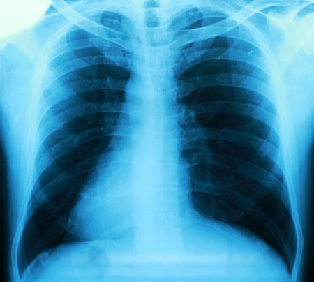 X-ray of a thorax の写真素材