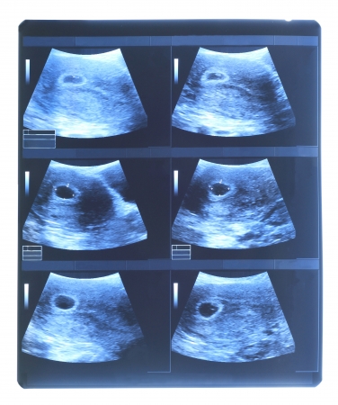 Ultrasound baby の写真素材