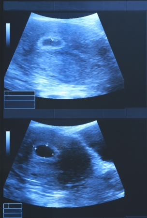 Ultrasound baby の写真素材