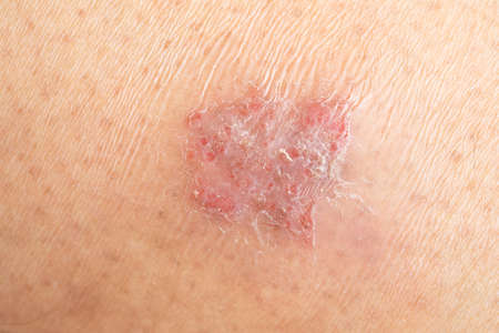 Dermatological skin disease on human skin