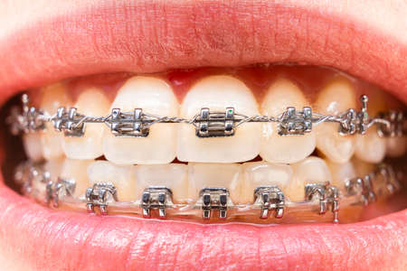 Foreground teeth with braces with traces of food. Dental care photo. Smile woman with orthodontic...
