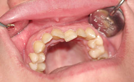 Malocclusion. Overcrowding of the teeth of the upper jaw