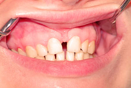 Diastema of the upper jaw and odontoschism of the lower jawの写真素材