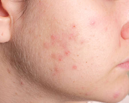 Acne on the girl's face. Image close-upの写真素材