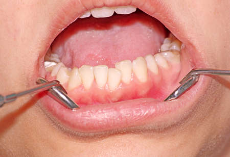 Malocclusion. Crowding of the teeth of the lower jawの写真素材