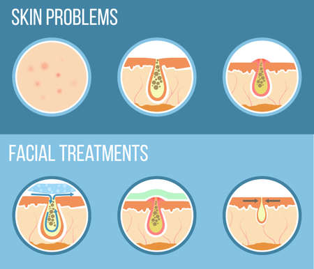 Skin problems such as acne, pimples and clogged pores. Facial treatment infographic, skin problems solution and skin care. Vector.のイラスト素材