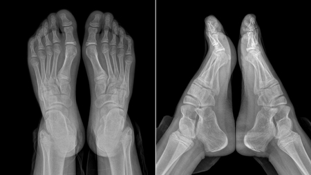 X-ray image of the girl's feet: two views with partially outlined socks and trousersの写真素材