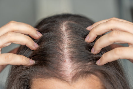 Close-up view of the head with traces of blood from injections after mesotherapy, treatment of alopecia conceptの写真素材
