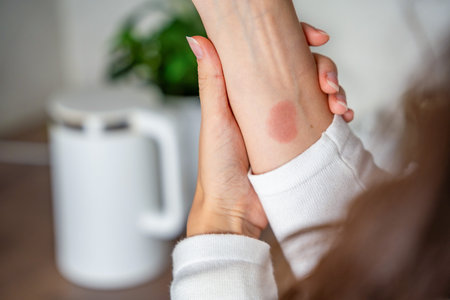Close up view of scald burn on a hand caused by steam from a kettle in a kitchen. Domestic accident...