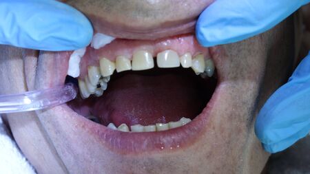 Cleaning Teeth And Patients Mouth