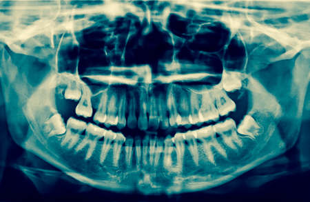 Dental X-Ray. A panoramic x-ray of a mouth, with intact wisdom teeth, one of which is severely...