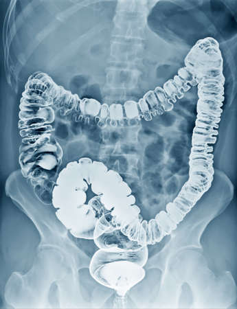 Film x-ray acute abdomen Chest AP,Abdomen viewの写真素材