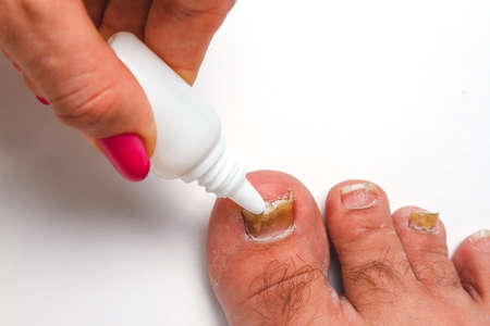 A toenail fungus at the peak of the infection.の写真素材