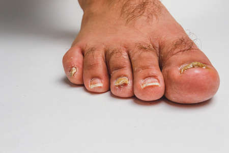 A toenail fungus at the peak of the infection.の写真素材