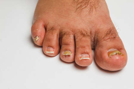 A toenail fungus at the peak of the infection.の写真素材