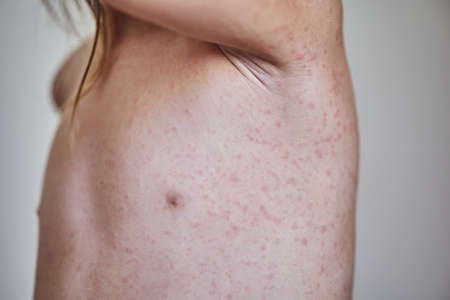 allergic rash on the body of the patient. 5 year old girl.の写真素材