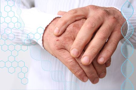 Close up of male hands with dry skin damage. Dermatology concept human hands with skin with cracks...