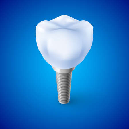 Isometric Concept of Human Dental Implant on Blueのイラスト素材