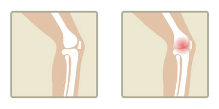 Healthy and sick knee. Flat design, vector illustration, vector.のイラスト素材