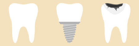 Tooth, tooth implant. Flat design, vector illustration, vector.のイラスト素材