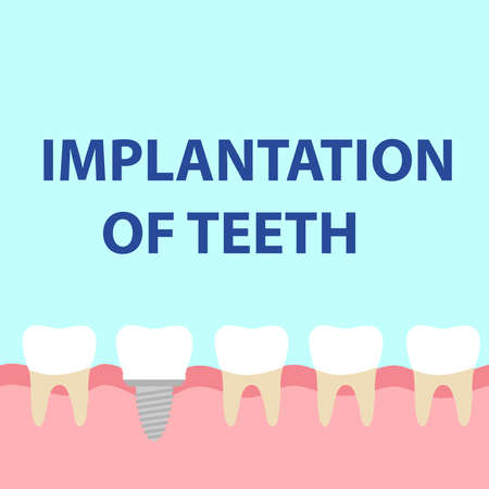 Dental implant model. Flat design, vector illustration, vector.のイラスト素材