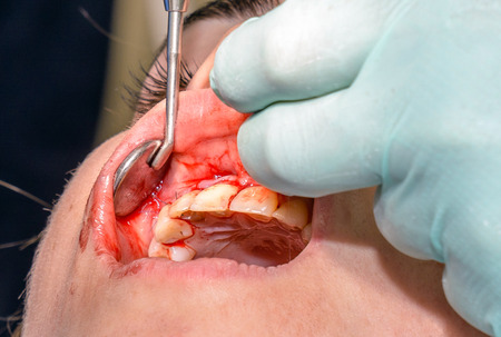Young women having teeth operationの写真素材
