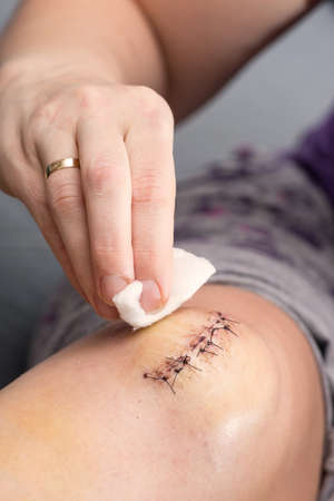 scar from operation with a black fiberの写真素材