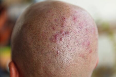 Man's shaved head with diseased skin, acne and eczemaの写真素材