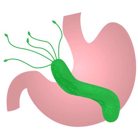 Helicobacter pylori in the stomach. vector illustrationのイラスト素材
