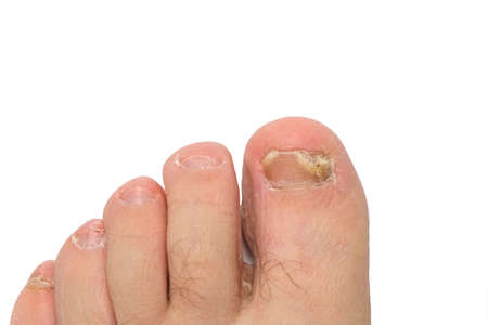 Fungus of toenails and human skin. Close-up. Isolateの写真素材