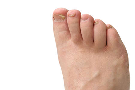 Fungus of toenails and human skin. Close-up. Isolate