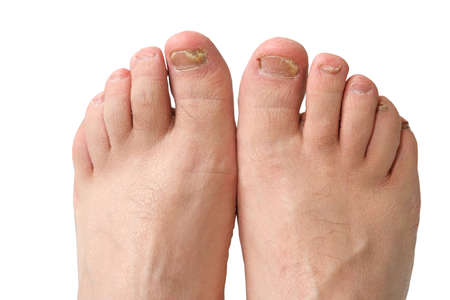 Fungus of toenails and human skin. Close-up. Isolateの写真素材