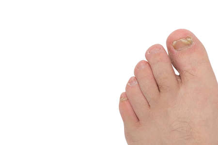 Fungus of toenails and human skin. Close-up. Isolateの写真素材