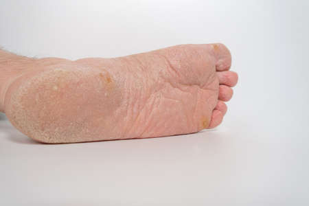 Fungus of the foot of a person. Close-up. Isolateの写真素材
