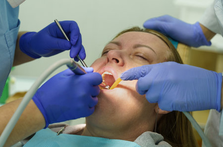 The dentist treats the teeth of the patient in the clinic. Close-up of the face, gloved hands, tools for dental treatment.の写真素材