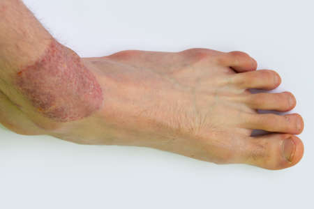 The foot suffers from dermatitis in the acute phase of allergy and psoriasis. The concept of...