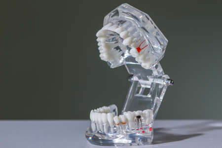 glass jaw model with implanted dentures