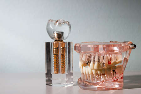 glass jaw model with implanted dentures