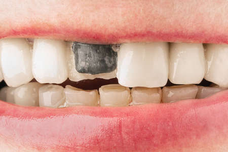 Broken metal-ceramic front tooth in female mouthの写真素材