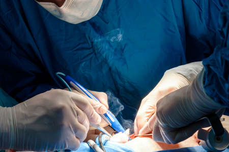 The surgeon holds the electrical coagulator during the minimally invasive operation. Close-up of...
