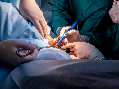 Selective focus on the hands of surgeons in sterile gloves working with medical instruments. Surgery on the anus to remove hemorrhoids and treat coloproctological diseases.の写真素材