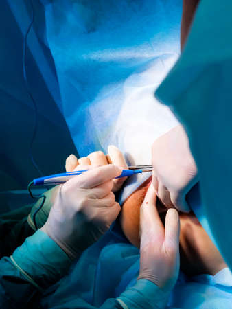 Selective focus on the hands of surgeons in sterile gloves working with medical instruments. Surgery on the anus to remove hemorrhoids and treat coloproctological diseases.の写真素材