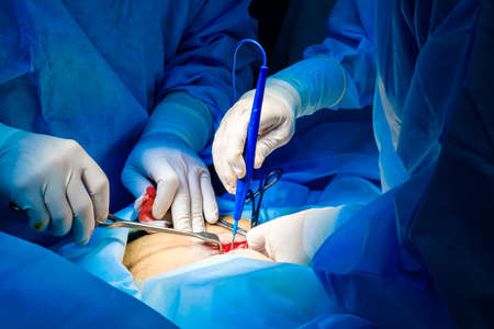 Close-up of the hands of surgeons in sterile gloves operate with an electric coagulator during a surgical operation.の写真素材