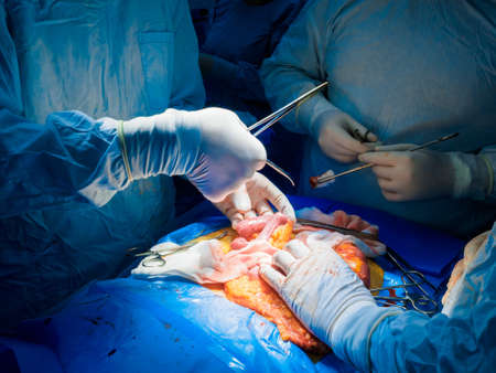 A team of surgeons performing abdominal surgery on a patient to remove a cancerous tumor in the intestines. Selective focus. Hands of surgeons during surgery on the abdominal cavity of a person.の写真素材